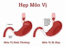 Hẹp Môn Vị Là Gì